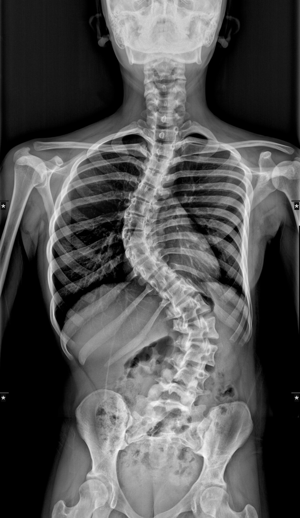 Radiografía preoperatoria de escoliosis