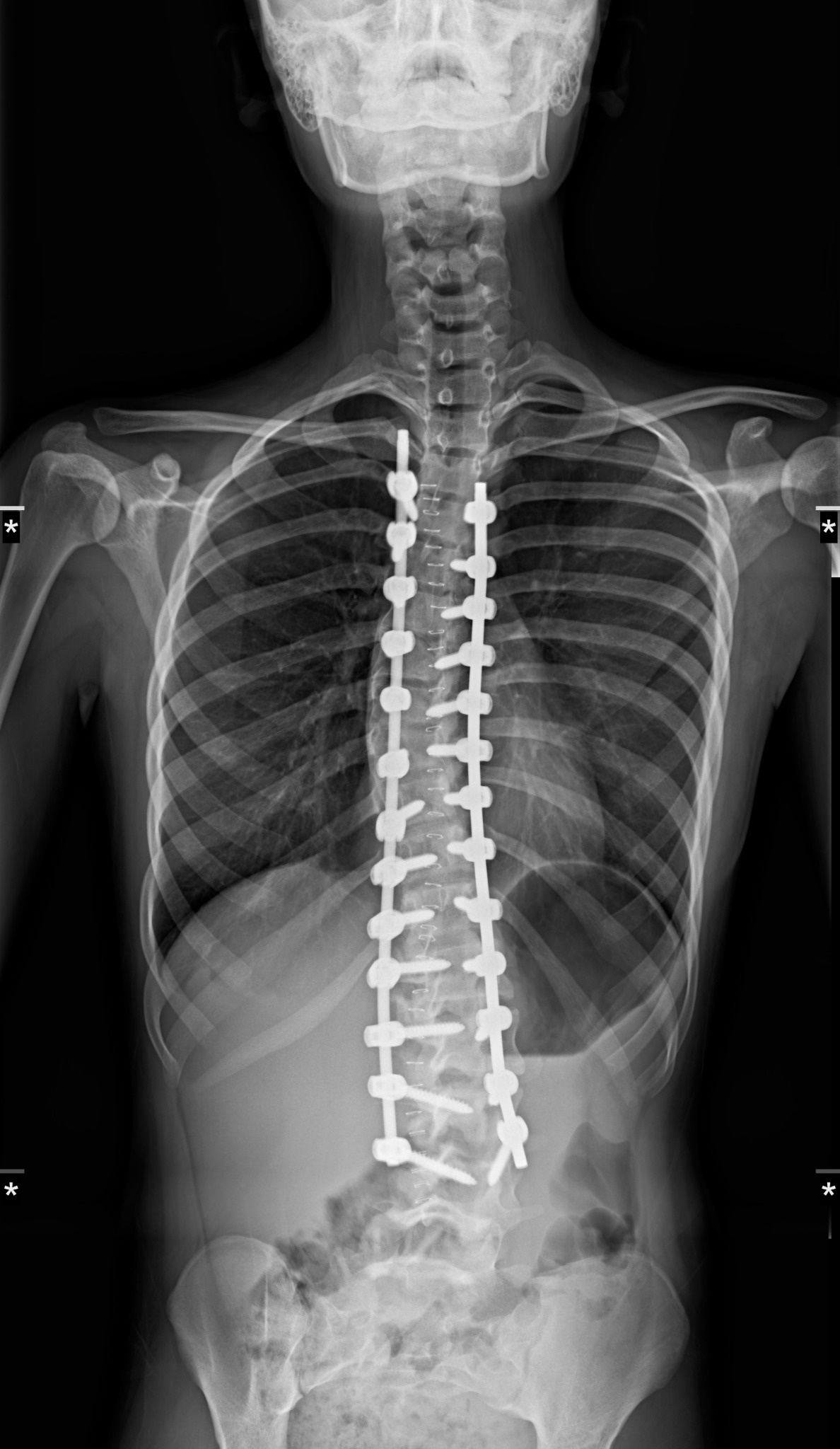 Radiografía postoperatoria de escoliosis